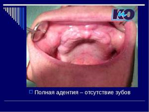 Признаки адентии