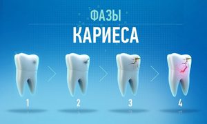 Основные причины кариеса и методы профилактики