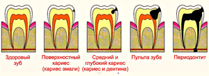 Как лечить кариес