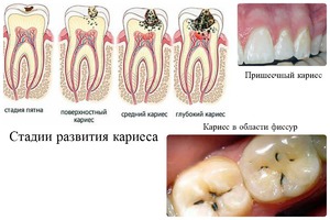 Глкбокий кариес