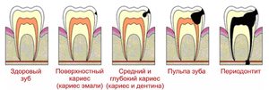 Почему появляется кариес