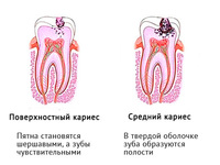 Лечение кариеса