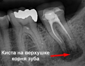 Как лечить кисту зуба