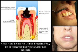 Основные причины возникновения флюса