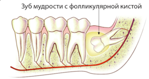 Фолликулярная киста фото