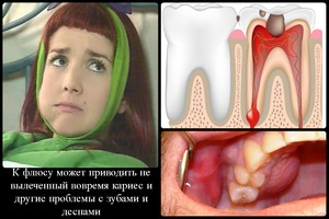 Флюс на десне