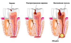 Развитие кариеса