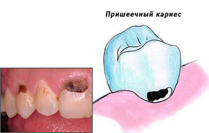 Как лечить кариес народными средствами