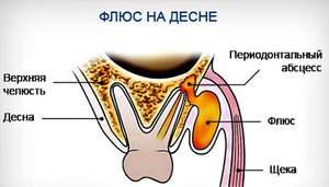Флюс на десне:что делать