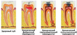 Периодонтит-лечение