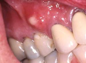 Гнойники на десне при абсцессе