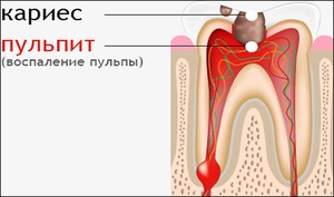 Как лесить периодонтит