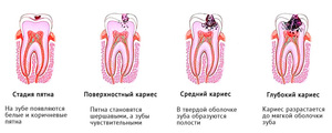 Стадия кариеса