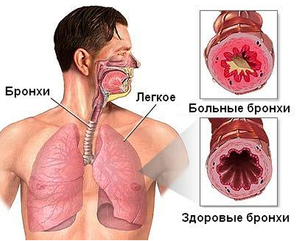 Бронхит-причина запаха изо рта