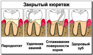 Закрытый кюретаж-описание