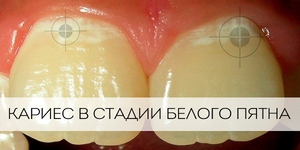 Белый кариес-что делать