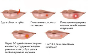 Какие стадии развития проходит герпес