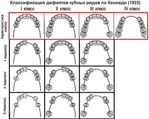 Классификация дефектов зубного ряда
