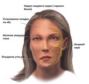 Медикаменты для лечения тройничного нерва