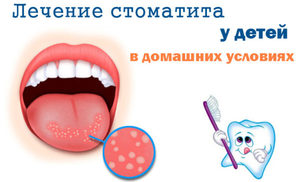 Методика лечения стоматита