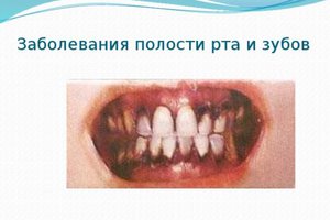 Признаки заболеваний полости рта