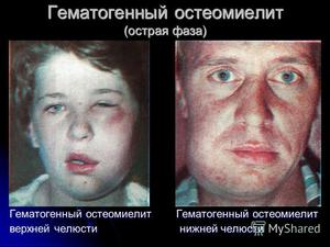 Гематогенный остеомиелит-симптомы