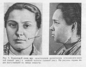 Хроническая стадия остеомиелита 