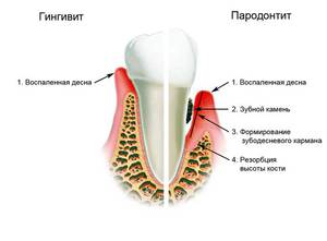 Гингивит-симптомы