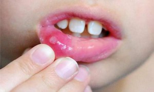 Признаки стоматита у детей
