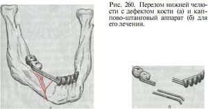 Перелом челюсти 
