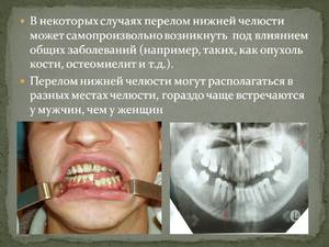 Перелом верхней челюсти