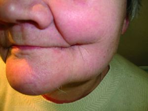 Рак щеки