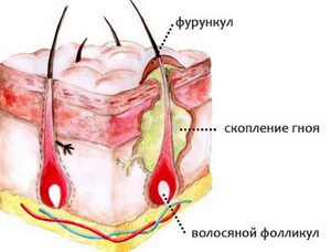 Фурункул и его лечение