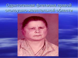 Флегмона околоушной области-описание