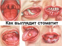 Герпесный стоматит - что это за болезнь