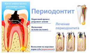 Способы лечения периодонтита