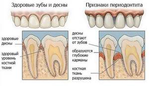 Методы лечения периодонтит