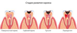 Как в домашних условиях лечить периодонтит