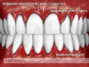Некротический стоматит
