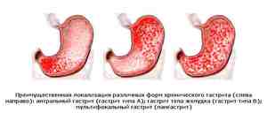 Заболевание гастрит