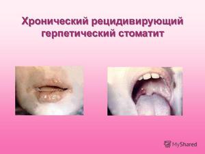 Как лечить герпетический стоматит