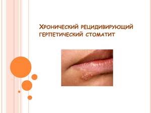 Почему возникает стоматит