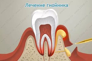 Лечение нарыва