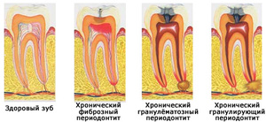 Формы периодонтита