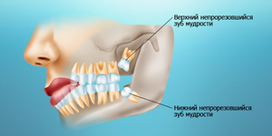 Какие осложнения могут быть 