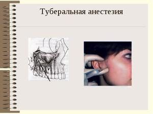 Туберальная анестезия