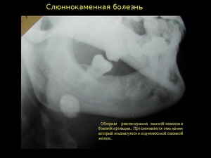 Как леччить слюннокаменную болезнь