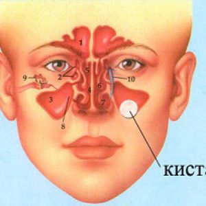 Киста и ее лечение