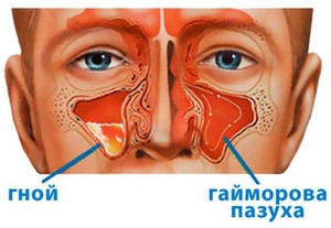Гайморит – симптомы
