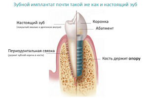 Техника имплантации